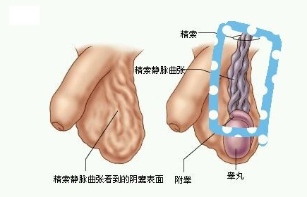 精索静脉曲张