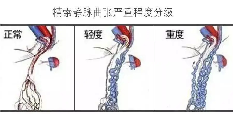 精索静脉曲张分级图