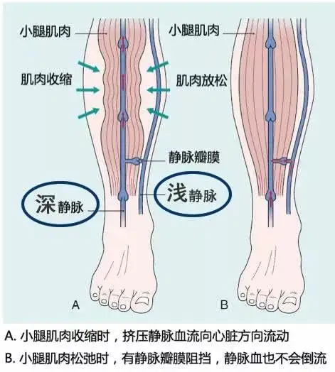 静脉曲张肌泵