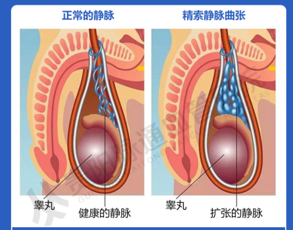 精索静脉曲张