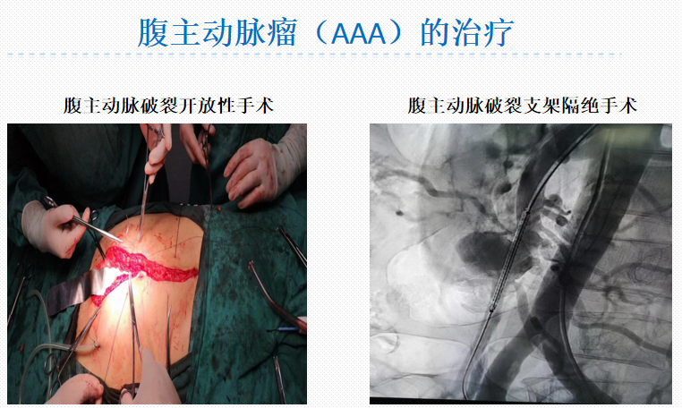 腹主动脉瘤治疗